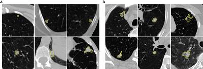 A Comparative Study of Radiomics and Deep-Learning Based Methods for Pulmonary Nodule Malignancy Prediction in Low Dose CT Images